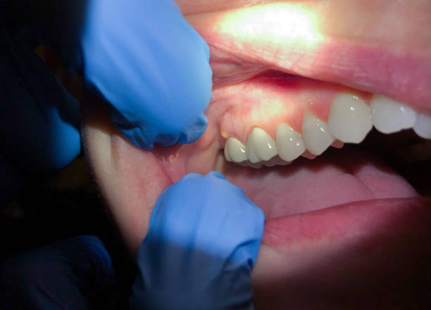 Best Emergency Dentist for Lost Fillings or Crowns in Horace, ND